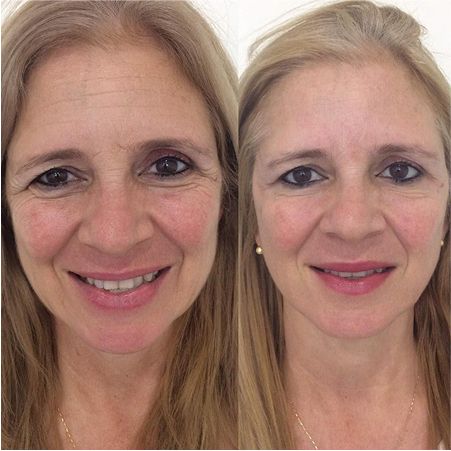 Antes e depois de um tratamento de Botox com técnica exclusiva.